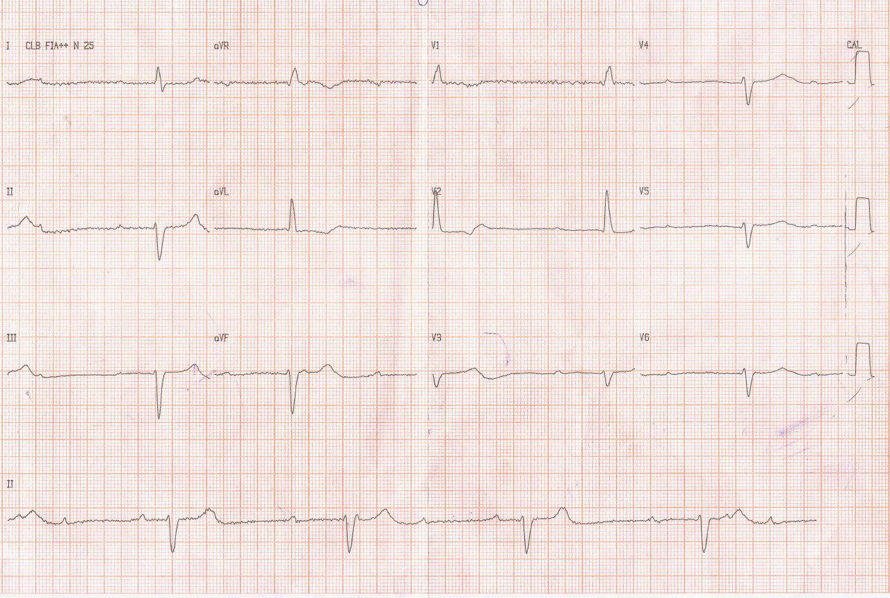 Mujer de 66 años con fatiga y presíncope por BAVC con un ritmo de escape lento de QRS ancho lo cual indica localización infranodal del BAV