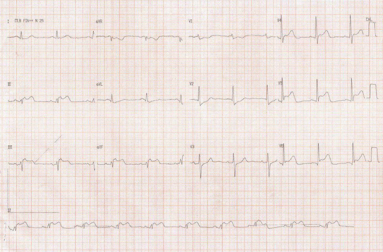 Paciente cursando SCA con ECG que sugiere enfermedad de Cx y CD y revascularización de vaso culpable (Cx)