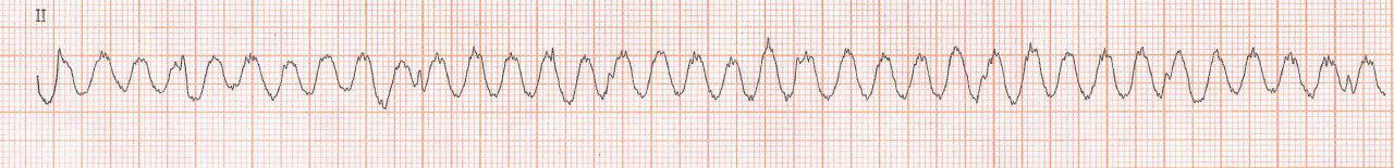 Paciente de 71 años que presenta temblor parkinsoniano con ECG que simula una taquicardia de QRS ancho