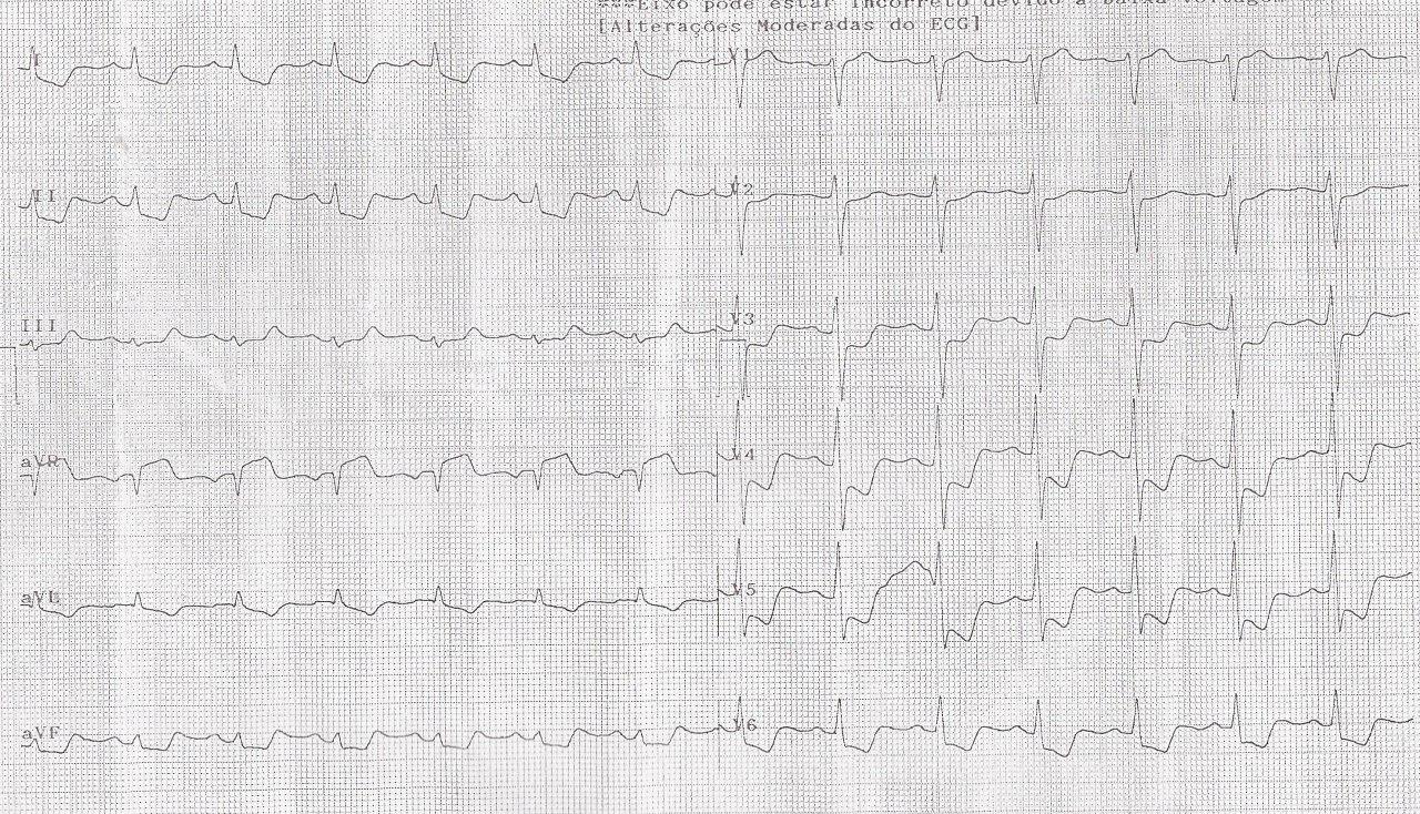 Hombre de 66 años portador de factores de riesgo que cursa con SCA que evoluciona al shock por suboclusión de TCI y obstrucción total de DA y Cx