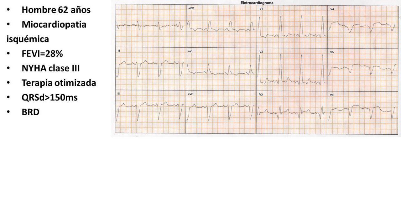 Paciente de 62 años portador de miocardiopatía isquémica con implante de CDI-R