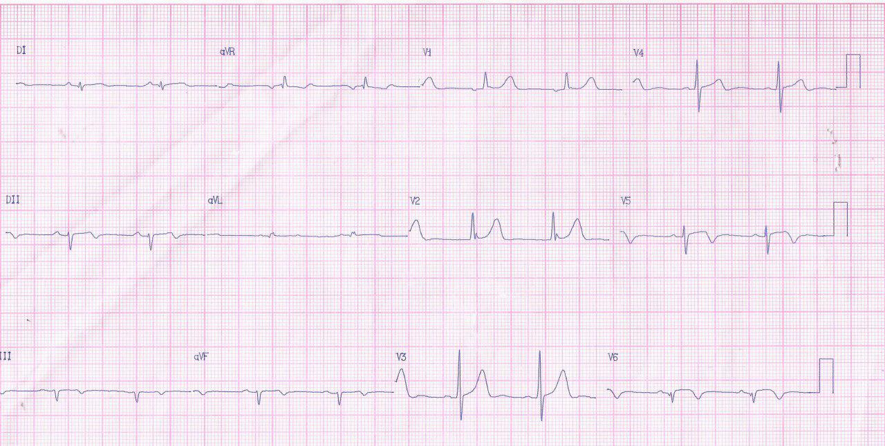Hombre de 74 años con SCA por compromiso de Cx al que se realiza angioplastia primaria con reperfusión incompleta