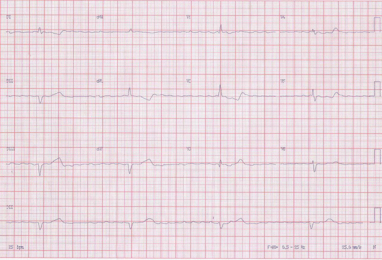 Hombre de 67 años portador de miocardiopatía chagásica que presenta episodio sincopal en el que se indica implante de MP CDI