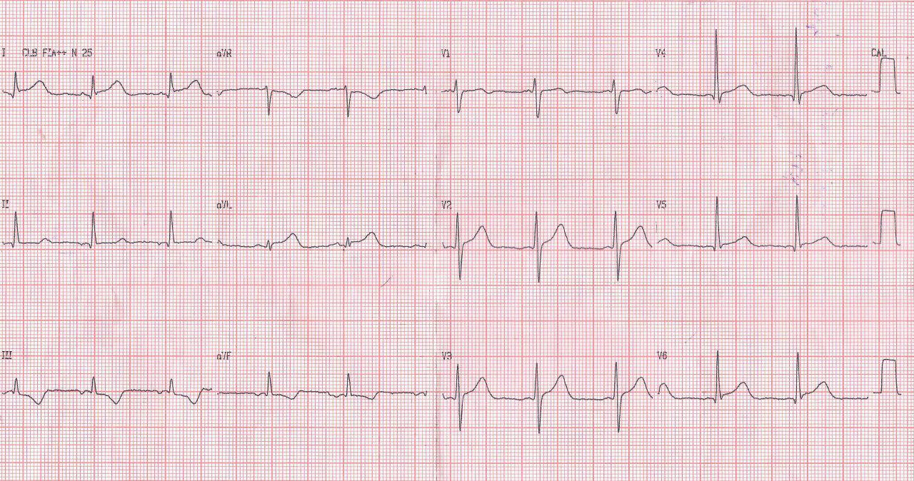 Paciente masculino de 44 años con SCACEST en D1 y aVL por compromiso de arteria 1ª diagonal