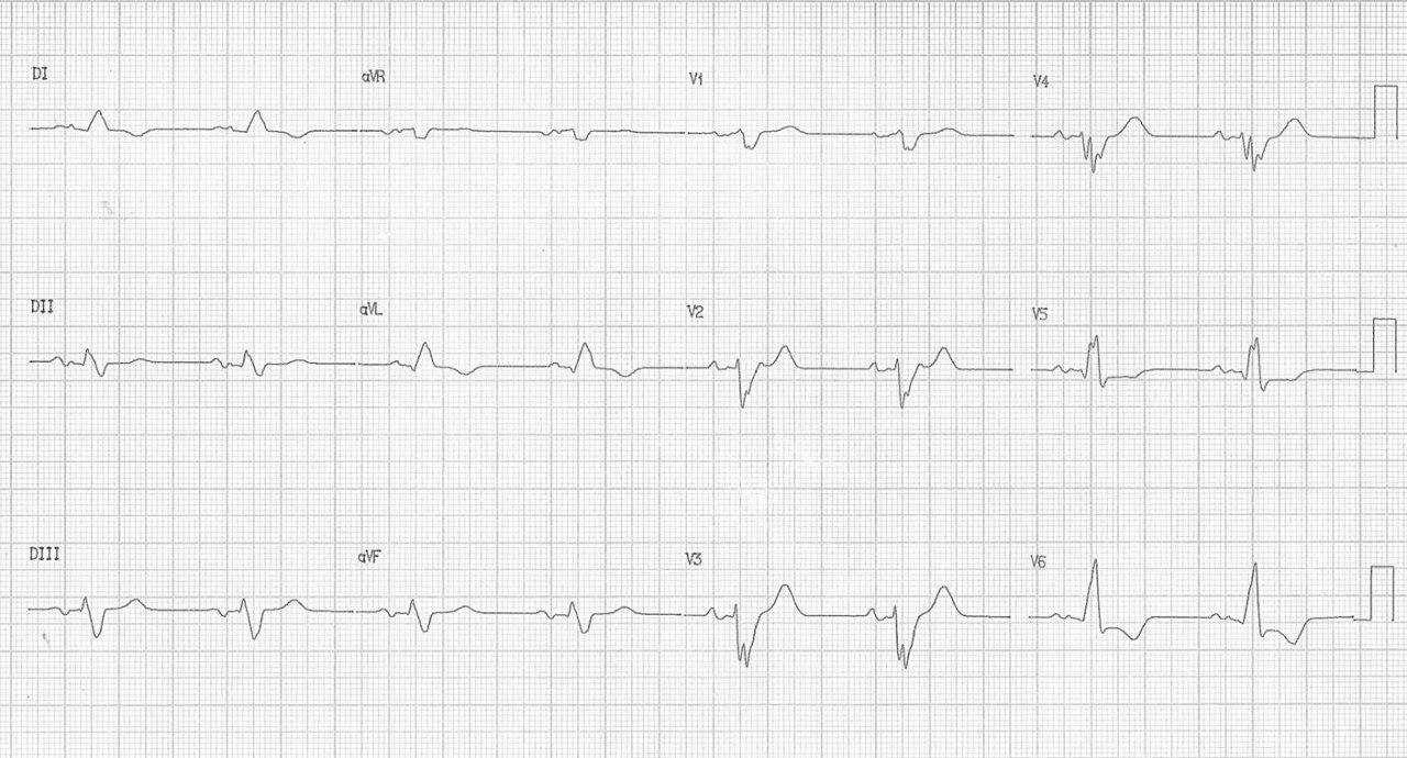 Mujer de 56 años portadora de miocardiopatía dilatada no isquémica, con antecedente de ACV isquémico en espera de implante de resincronizador