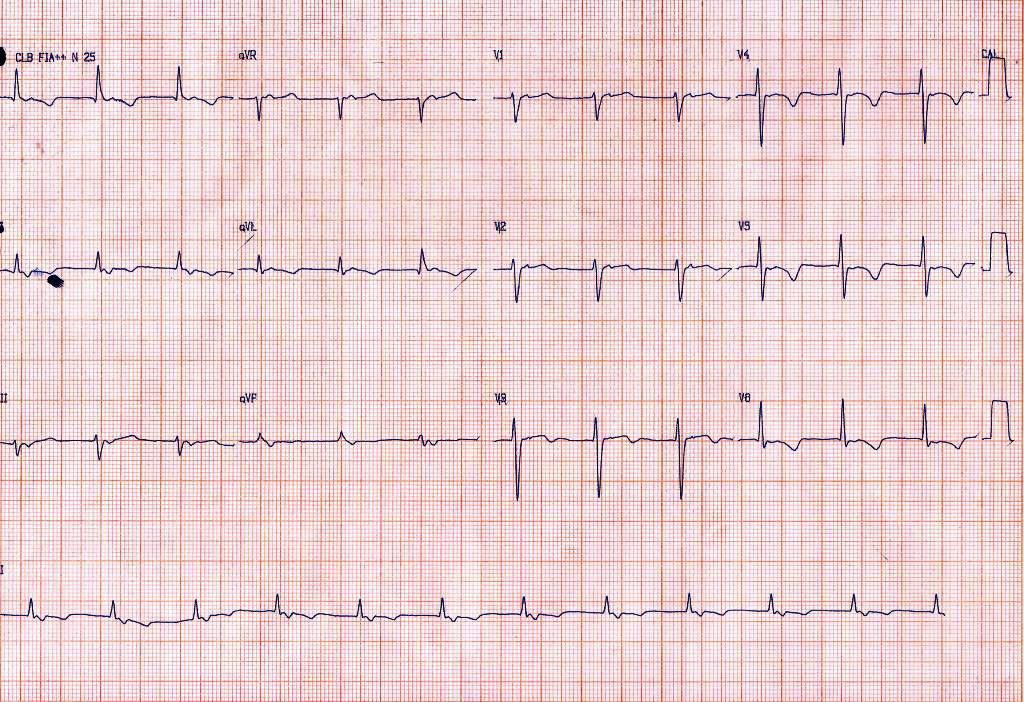 Paciente que cursa postoperatorio de reemplazo valvular aórtico con prótesis mecánica que presenta ritmo de la unión con retroconducción y restauración espontánea de RS