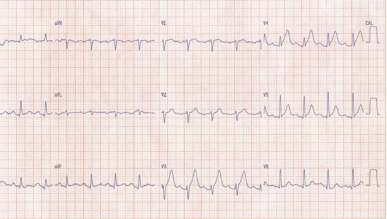 Paciente en IRC no dialítica que presenta angor prolongado por obstrucción total de la DA