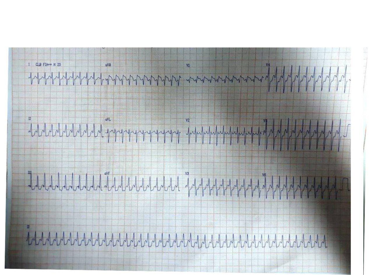 Paciente de 48 años que desarrolla taquimiocardiopatía por aleteo auricular 1:1 que no revierte con adenosina