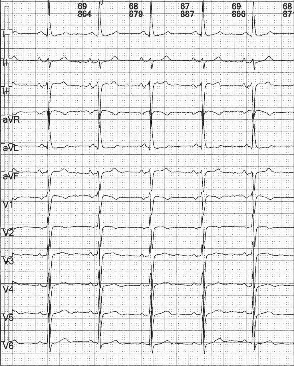 Paciente de 76 años que presenta BIA-A