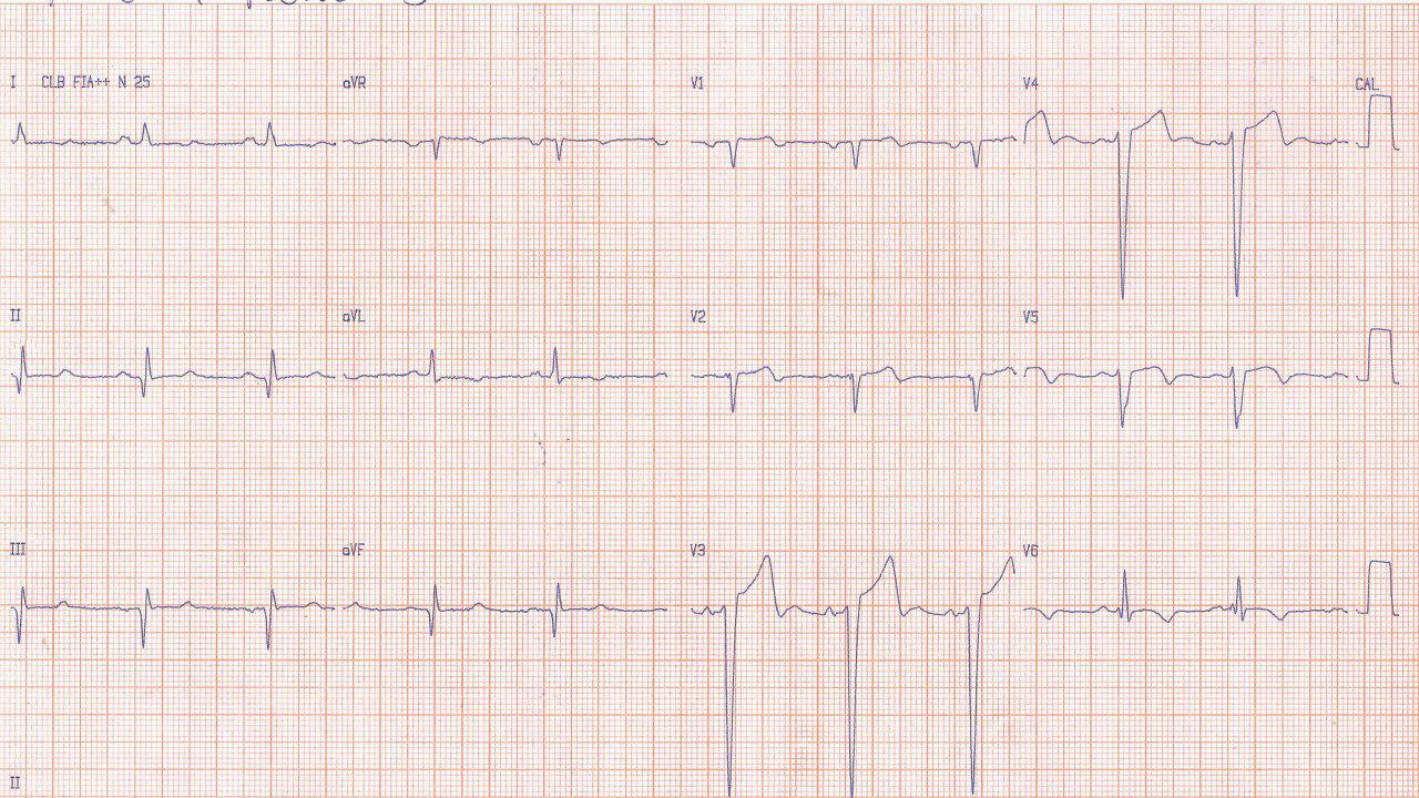 Paciente de 67 años, hipertenso y fumador con angor prolongado por compromiso de TCI, DA, Cx y CD