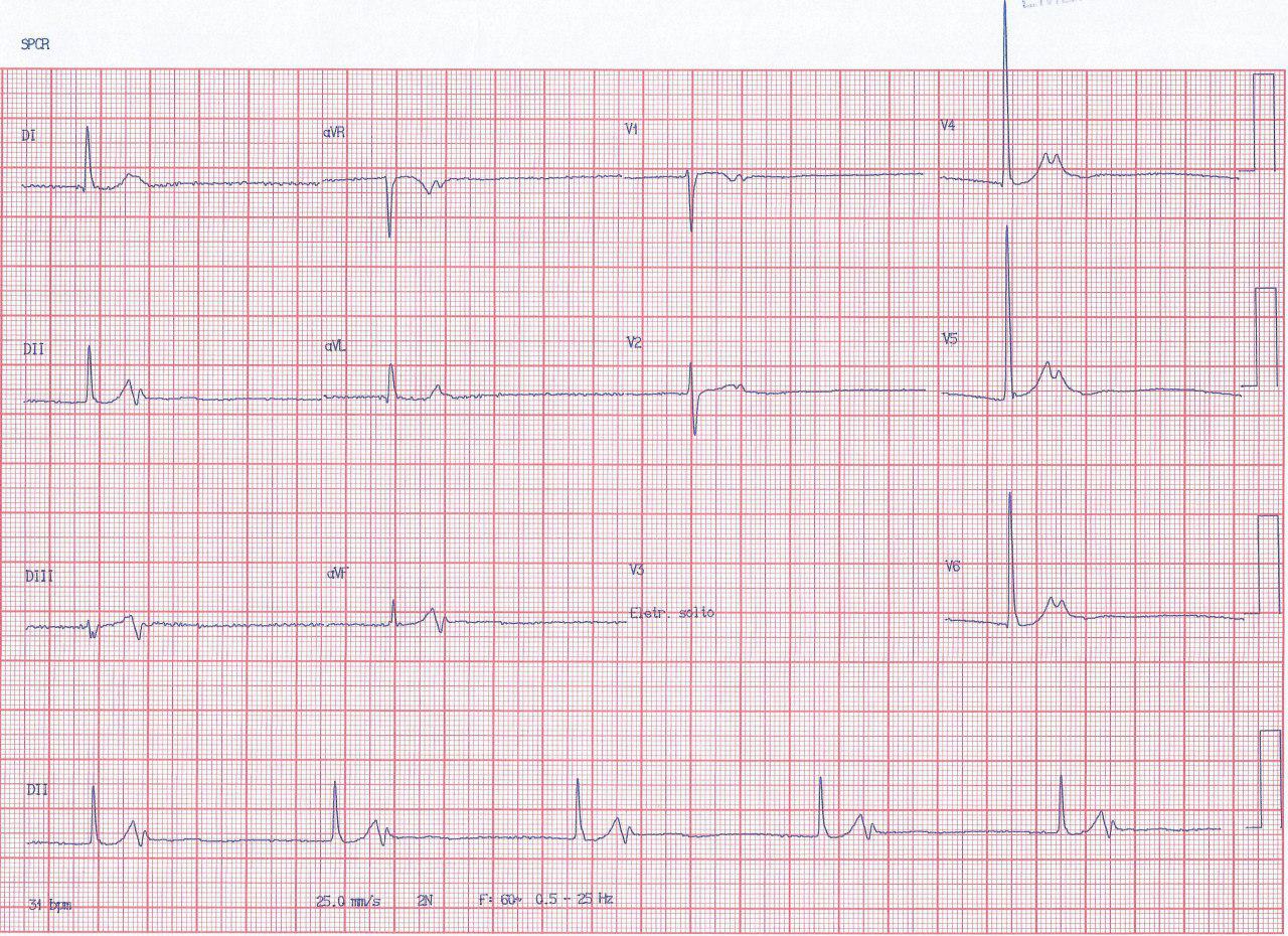 Paciente masculino de 46 años con palpitaciones tratado previamente con amiodarona que presenta enfermedad del nódulo sinusal con conducción retrógrada VA y episodios de FA y presencia de ondas T electrotónicas