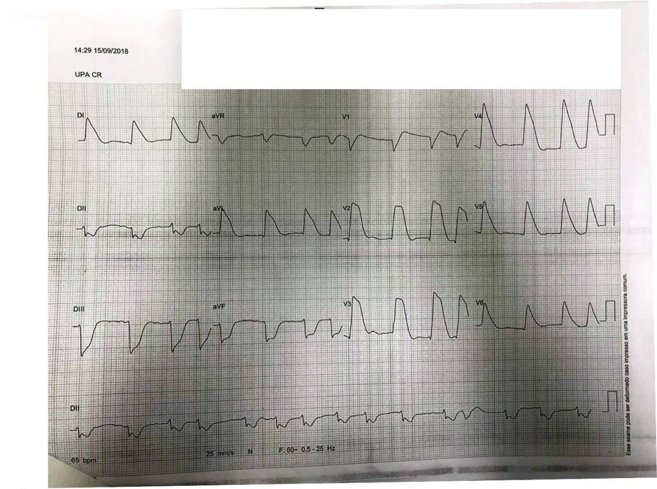 Hombre de 58 años con angor prolongado seguido de FV que es recuperada constatándose presencia de ondas lambda por compromiso de TCI y DA