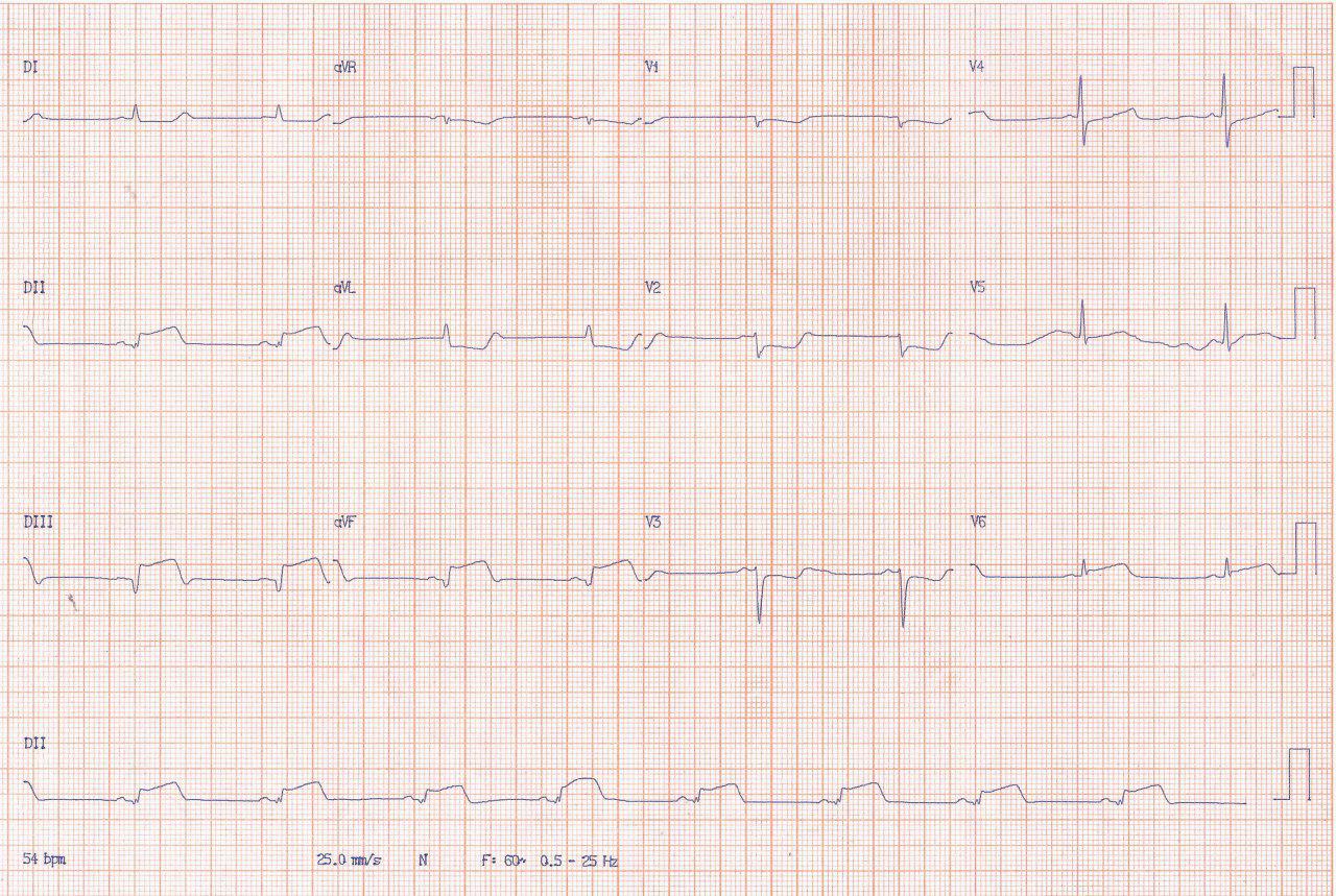 Mujer de 67 años con ardor epigástrico y sudoración y posterior síncope por presencia de IAM inferior y BAVC intermitente