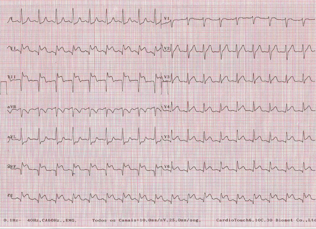 Hombre de 30 años con angor prolongado y síncope después de consumo de cocaína por trombo en CD que es aspirado con reperfusión