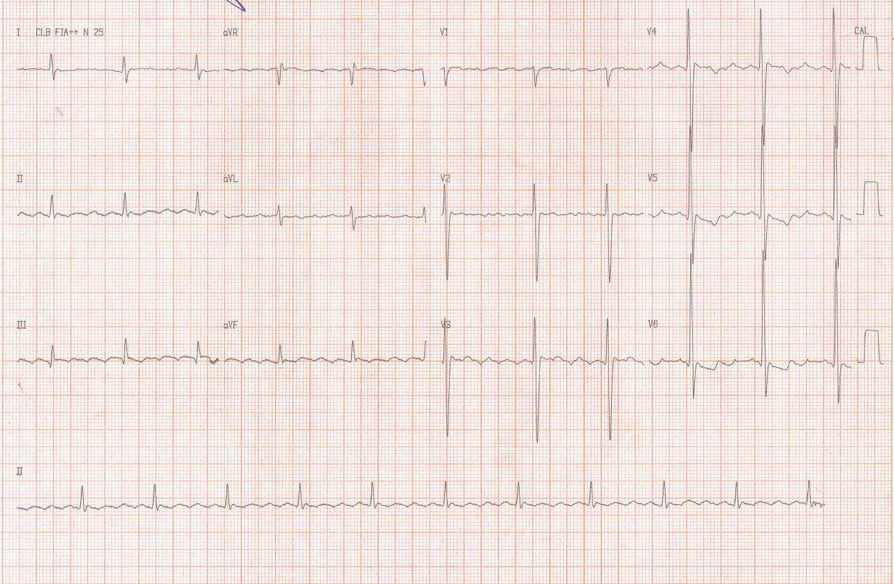 Masculino de 60 años con factores de riesgo y cuadro de angor progresivo con angor prolongado actual y troponina + que presenta fibriloaleteo con lesión con trombo en DA