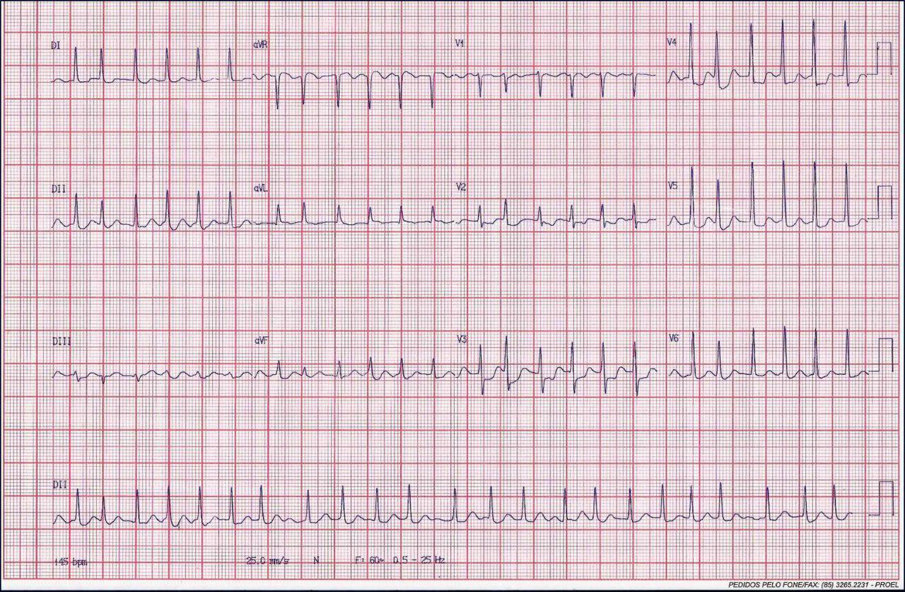 Mujer de 56 años con cefalea súbita, pérdida de consciencia y midriasis bilateral