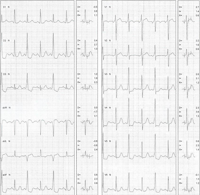 Mujer de 31 años con palpitaciones que realiza PEG en la que se detecta presencia de Wolff Parkinson White intermitente