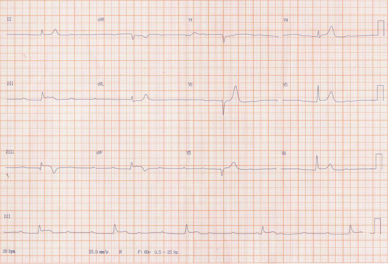 Paciente hombre de 60 años, diabético y dislipémico con SCA por compromiso de CD antes del ramo que irriga NAV y  enfermedad difusa de demás arterias coronarias con PCI a vaso culpable y CRM programada