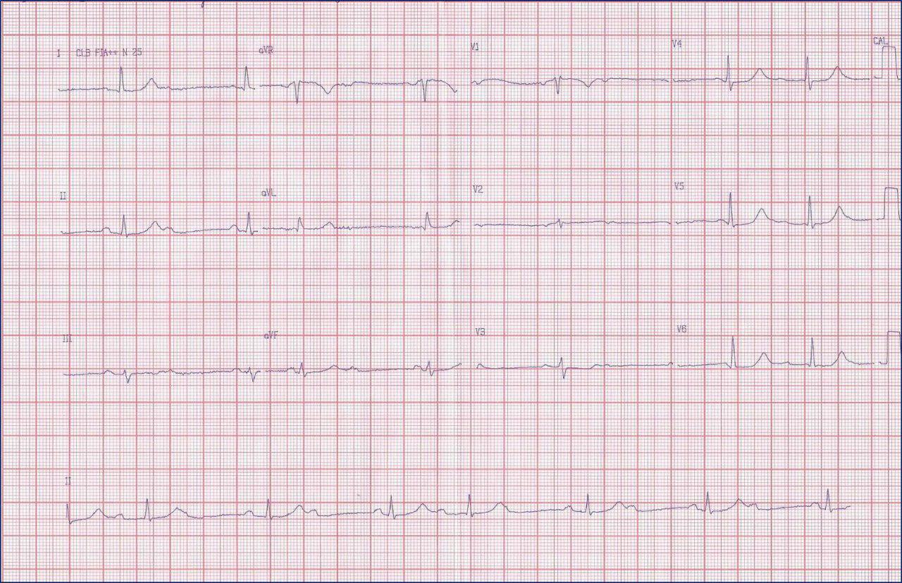 Mujer de 58 años tratada con digoxina que presenta bloqueo AV de segundo grado tipo II que se suspende persistiendo el bloqueo