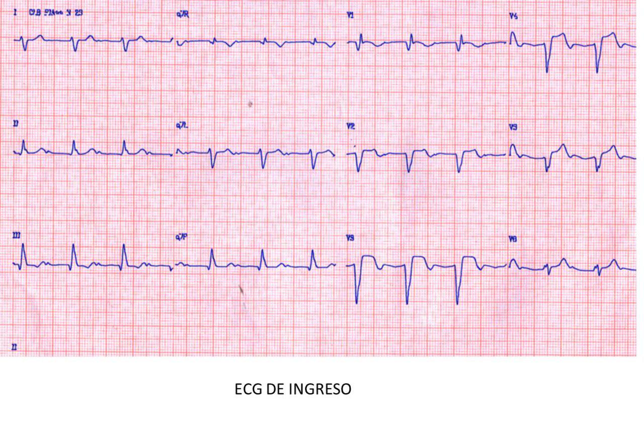Paciente de 71 años que cursa IAM complicado con BRD + HbPI + BAV 1º al que se implanta MP transitorio y que se complica con AA 2:1 por oclusión completa de DA