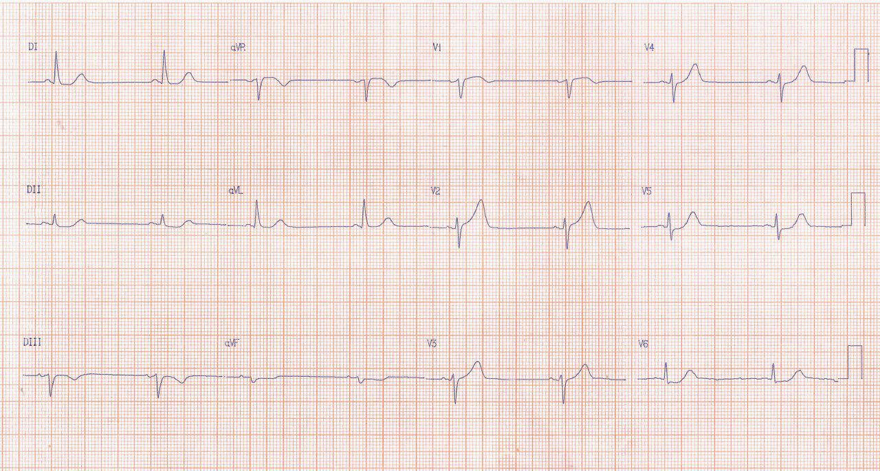 Paciente hipertenso que cursa con angor prolongado y síntomas vagales por isquemia grado 1 e infarto auricular
