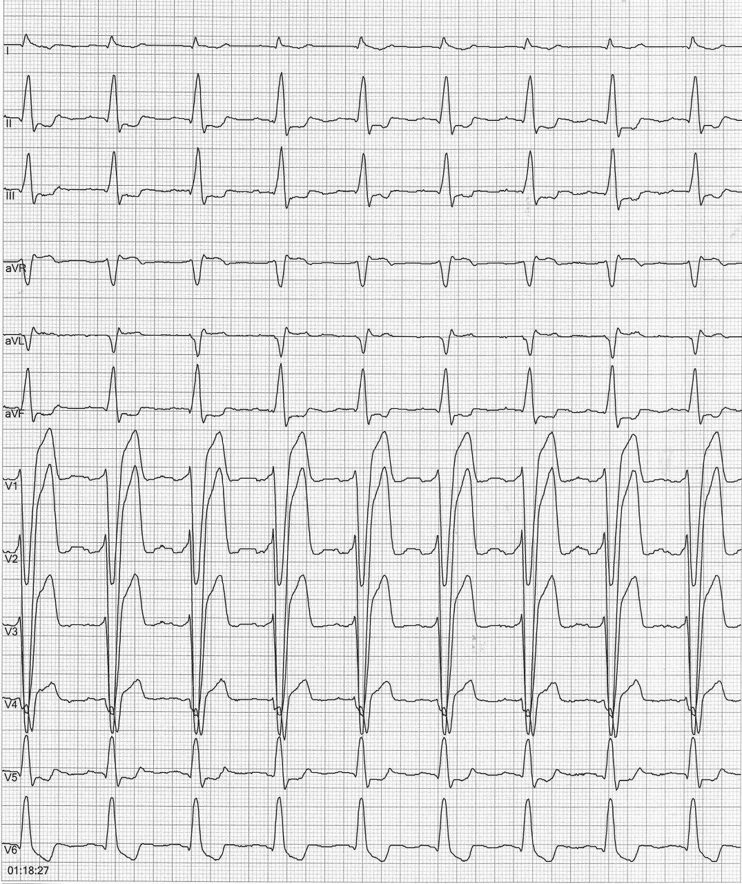 Paciente masculino de 55 años,  diabético, asintomático que presenta signos ECG de miocardiopatía isquémica y presencia de hipoquinesia difusa a predominio de cara anterior