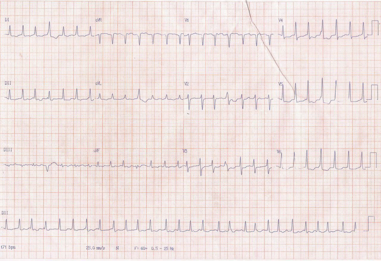 Mujer de 58 años que presenta taquicardia con inestabilidad hemodinámica por presencia de vía anómala pósteroseptal derecha
