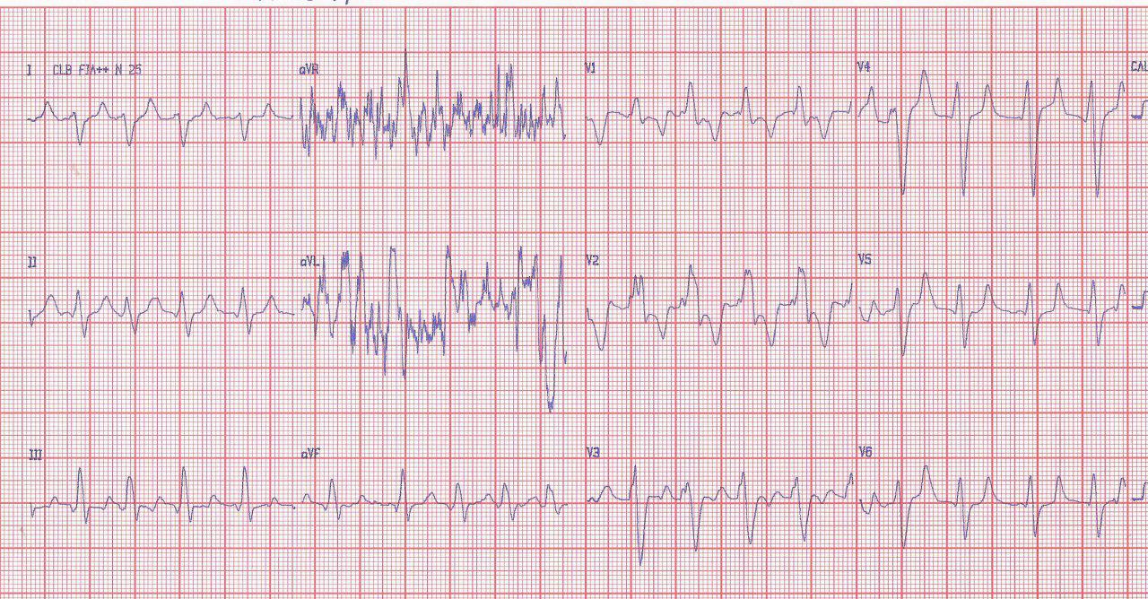 Paciente masculino de 34 años portador de bioprótesis infectada en tratamiento antibiótico e hiperkalemia que presenta disnea, hipotensión y disminución de la consciencia