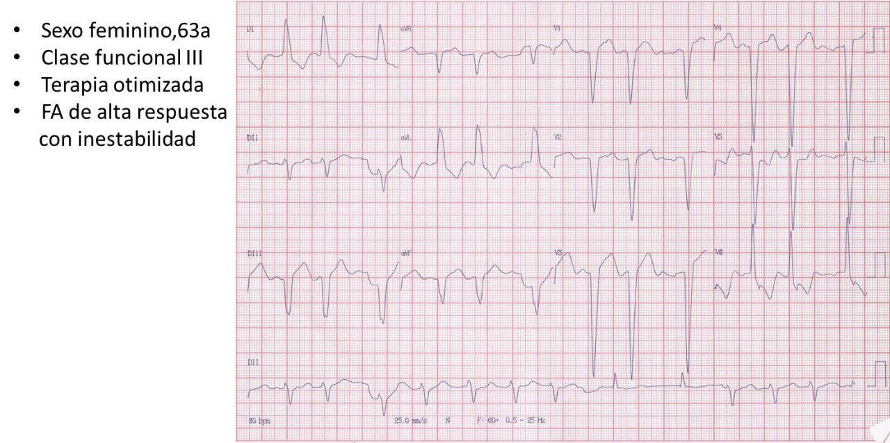 Mujer de 63 años que presenta FA con alta respuesta ventricular y descompensación hemodinámica por presentar miocardiopatía hipertrófica obstructiva a quién se practica miomectomía exitosa