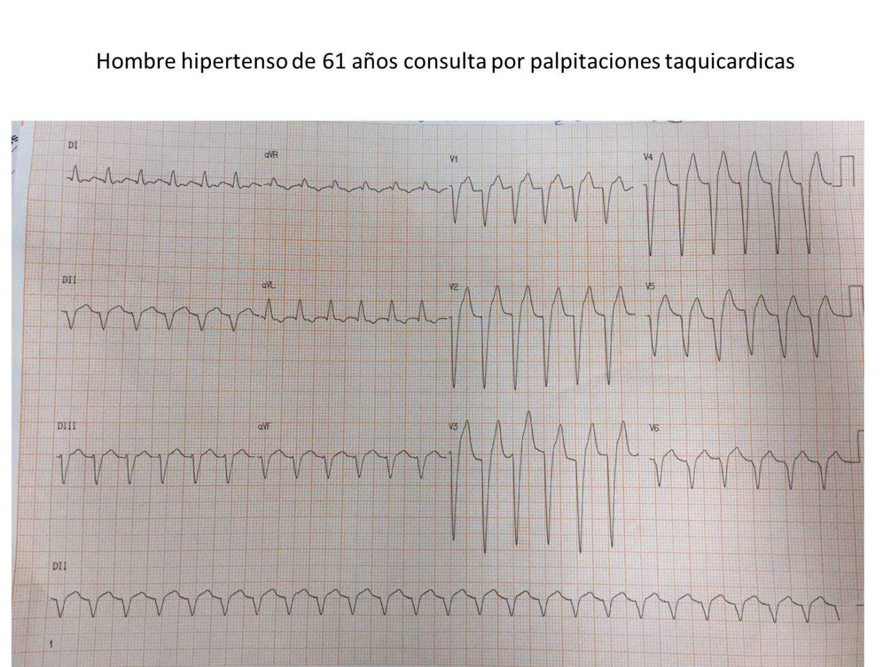 Hombre hipertenso de 61 años que presenta palpitaciones recurrentes y en quién la inyección de adenosina permite desenmascarar un aleteo auricular