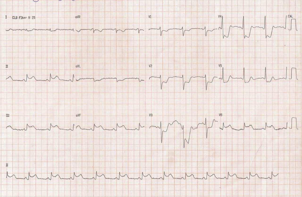 ECG de paciente cursando SCA por afectación de DA y CD