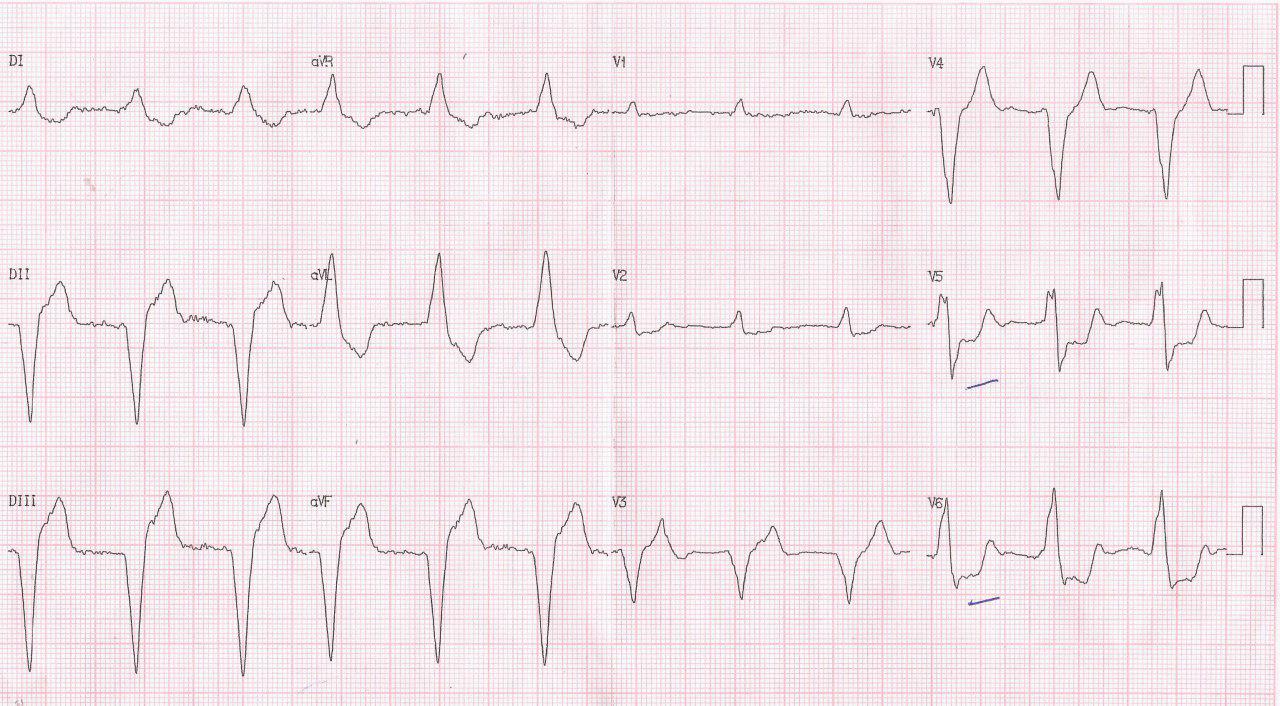 Paciente de 88 años portador de MP que presenta angor prolongado por SCA