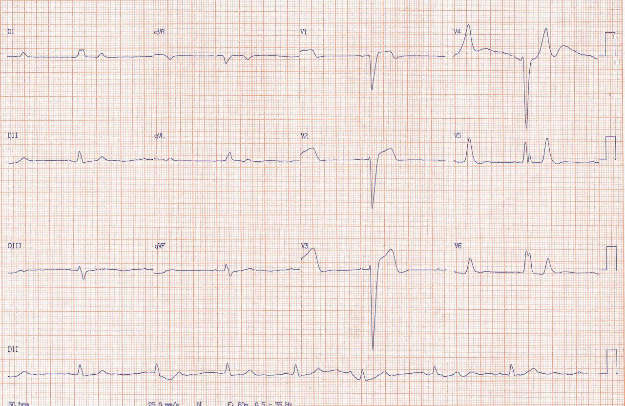 Hombre de 57 años con arterias coronarias normales que presenta mareos