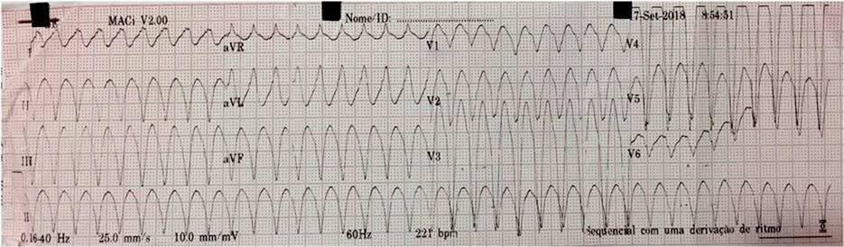 Paciente masculino de 78 años hipertenso y portador de cardiopatía isquémica con palpitaciones y mareos por presentar taquicardia por reentrada rama a rama