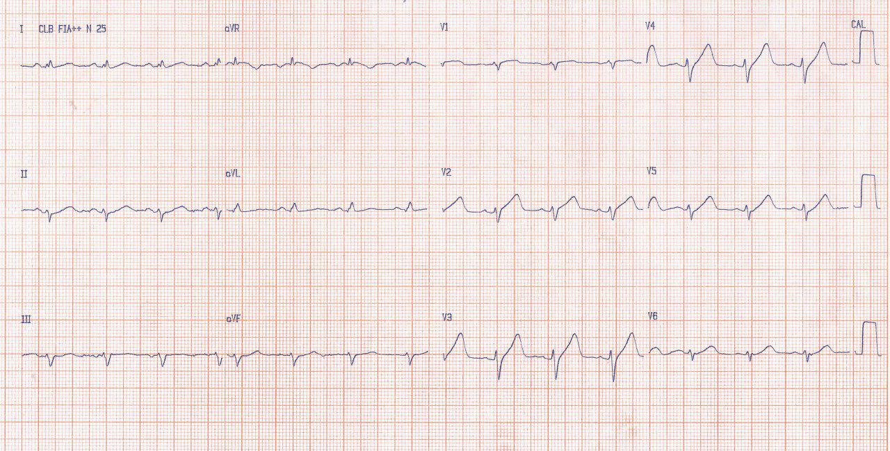 Hombre de 44 años que a raiz de un IAMCEST recibe implante de stent en la DA con presentación de angor 24 hs post procedimiento debido a trombosis intrastent y reimplante de nuevo stent farmacológico