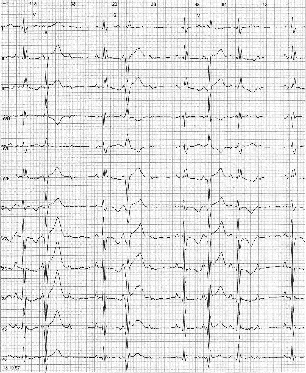 Holter de 12 derivaciones que muestra BAV por conducción oculta en el nódulo por extrasistolia ventricular