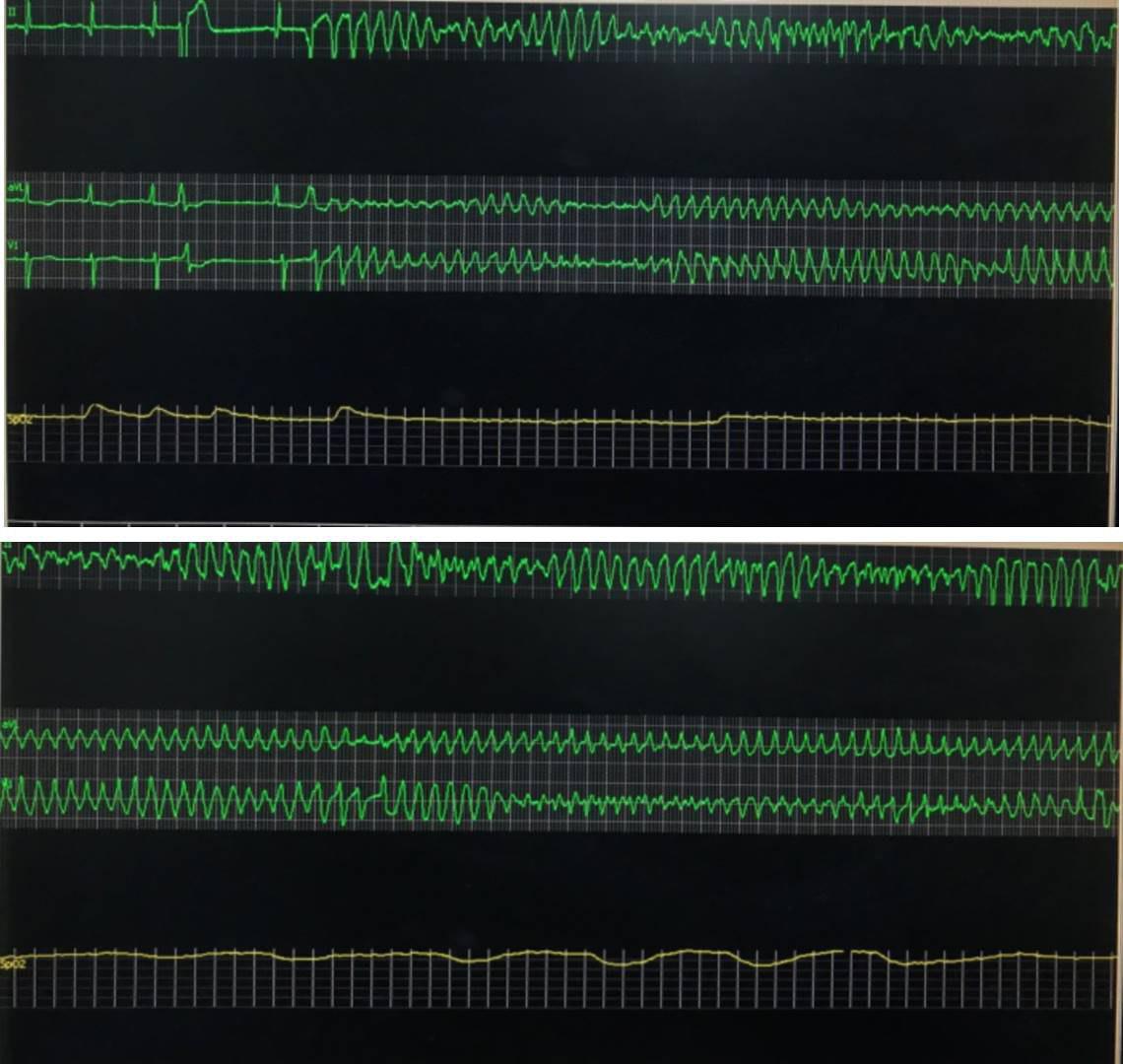 Masculino de 74 años con antecedente de cirugía de by pass con puente venoso aorto coronario a la DA hace 10 años que presenta síncope por presentar TdP debido a obstrucción del puente venoso y de Cx