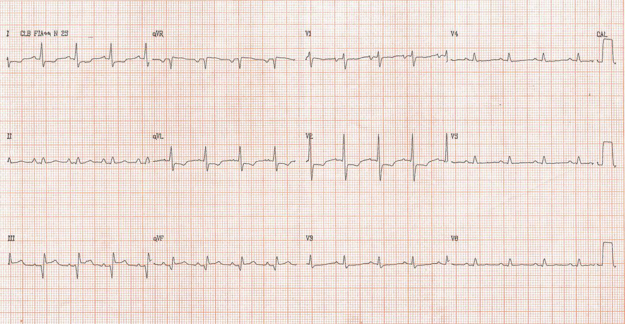 Paciente masculino de 74 años con antecedentes de dos cirugías previas de revascularización que presenta angor y en quién se detacta TV originada en aneurisma apical