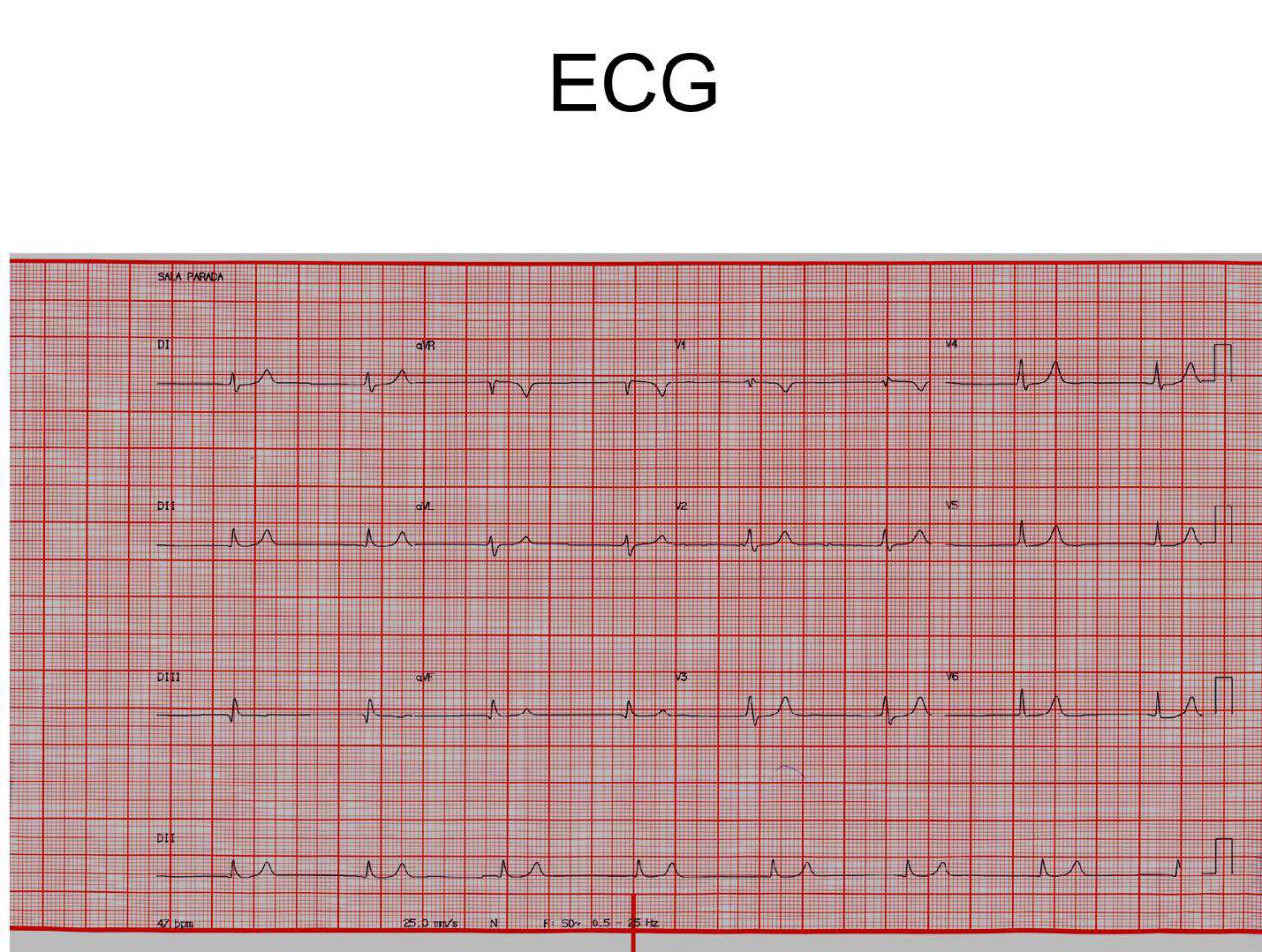 Paciente de 85 años, hipertenso, diabético y con insuficiencia renal con disnea progresiva que presenta severa hiperkalemia de 7,7 mEq/l