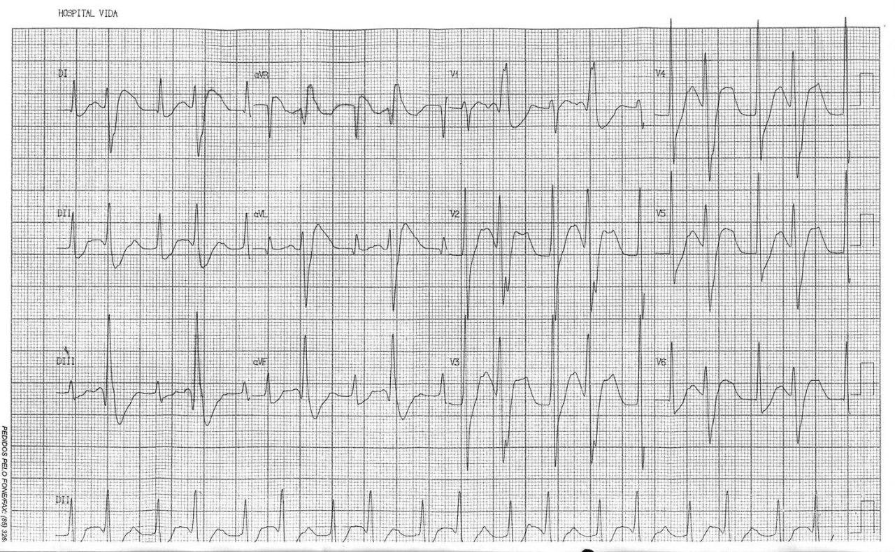 Hombre de 53 años con cuadriparesia a predominio de MI por hipokalemia de 1,7 mEq/l que mejora al corregirse el déficit con aporte EV de ClK