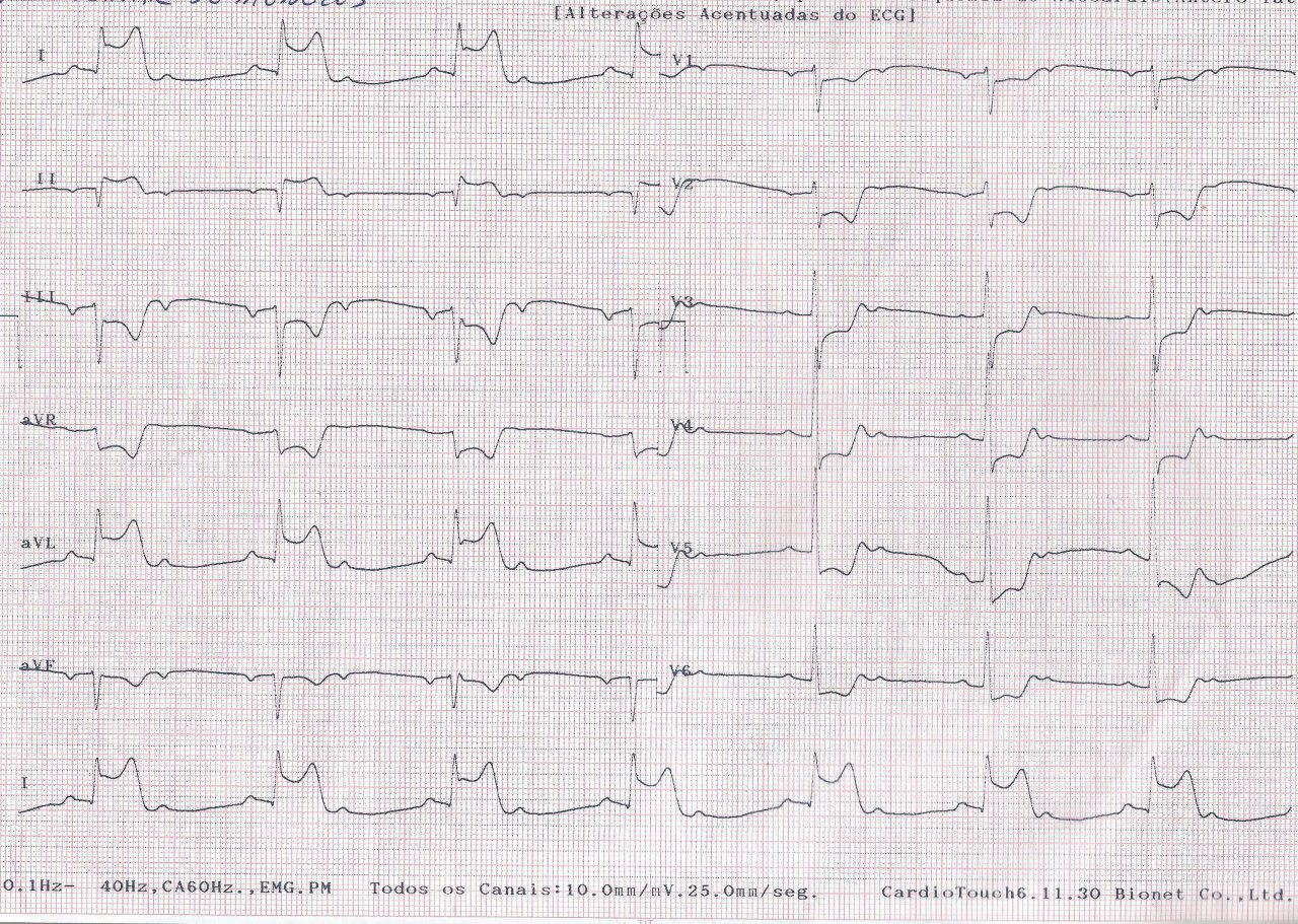 BAV 2:1 en contexto de SCA por compromiso multivasos