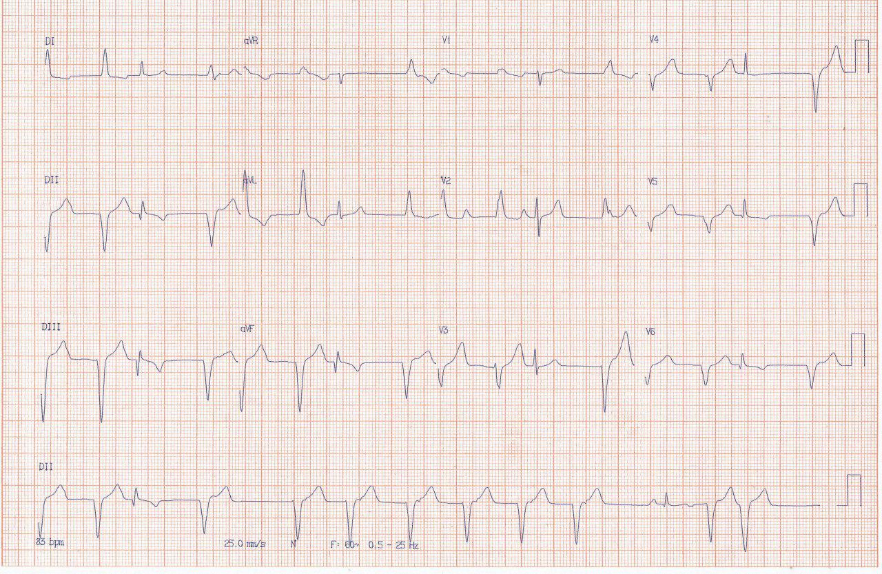 Mujer de 61 años con episodio de angor prolongado que muestra un RIVA en el ECG posiblemente por reperfusión espontánea y lesión significativa en tercio medio de la CD