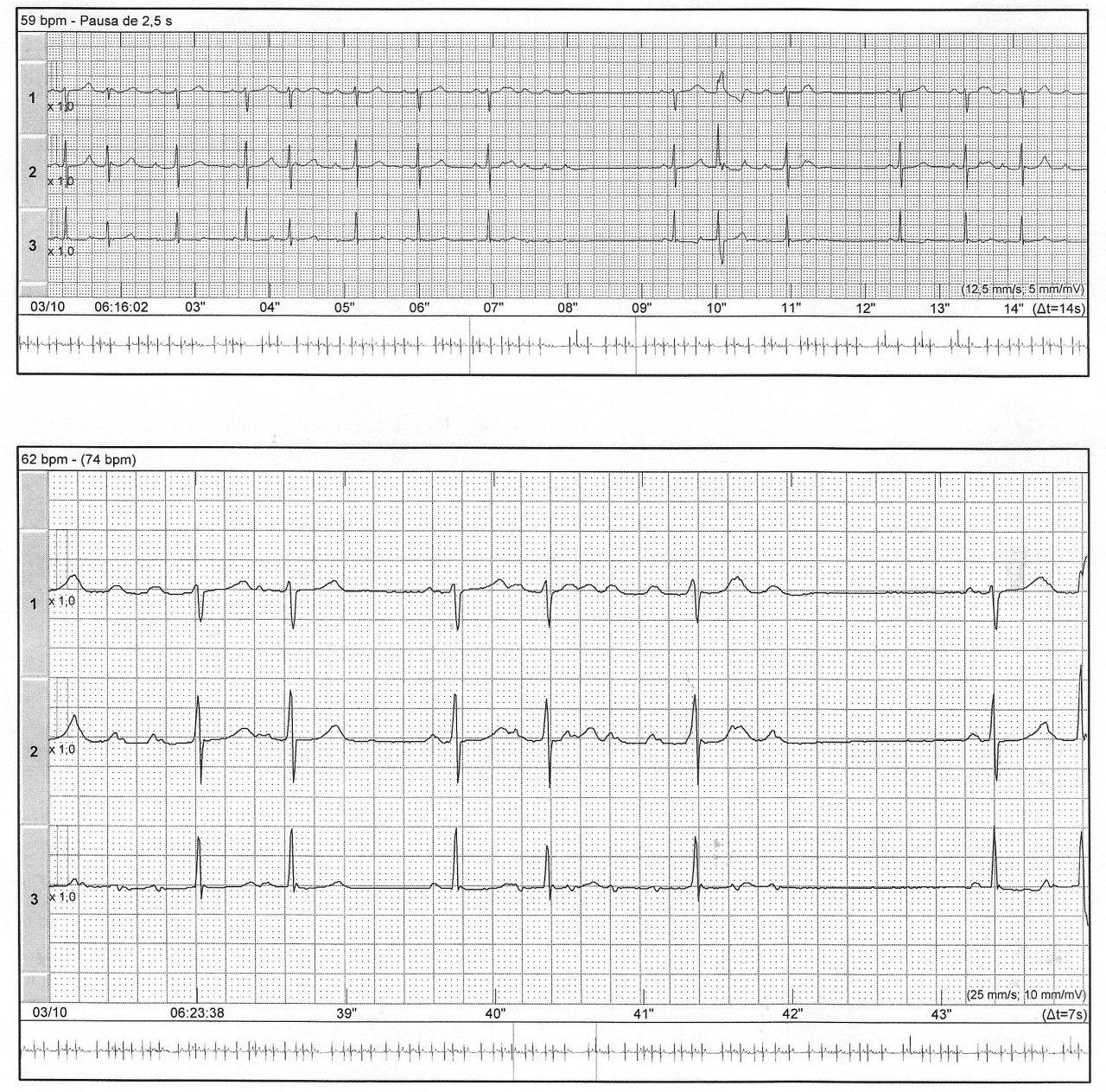 Holter de mujer hipertensa con palpitaciones para mostrar la presencia de Fenómeno de Ashman