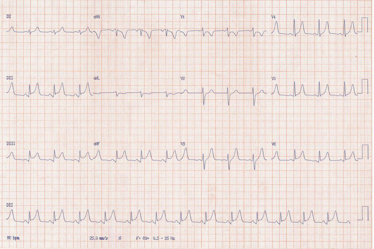 Paciente masculino de 21 años que presenta dolor precordial y parestesia de brazo izquierdo con ECG compatible con espasmo coronario o miocarditis aguda
