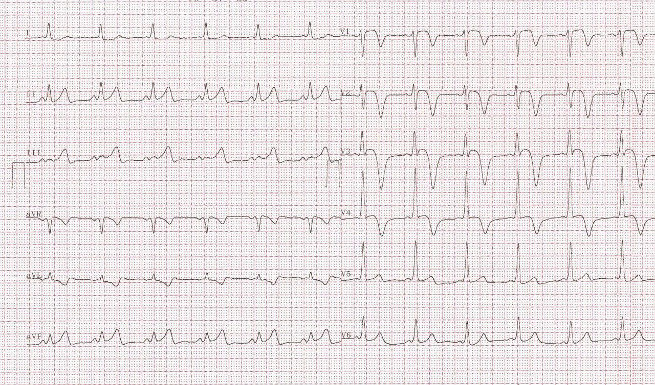 Paciente masculino de 49 años con SCA por compromiso de DA proximal asociado a WPW