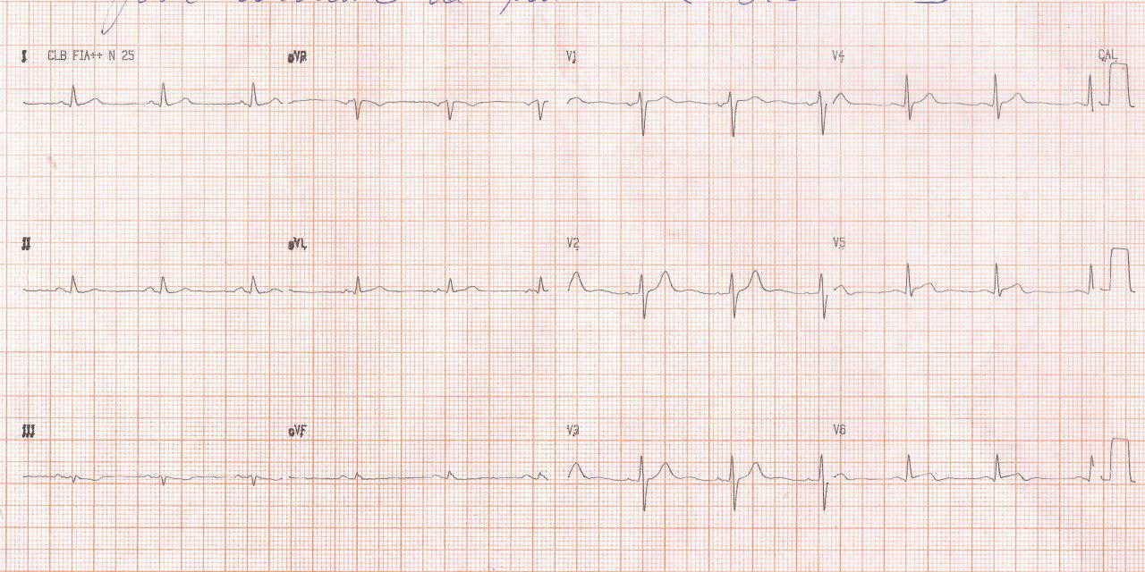 Paciente masculino de 51 años con angor prolongado por compromiso silencioso de la arteria Cx