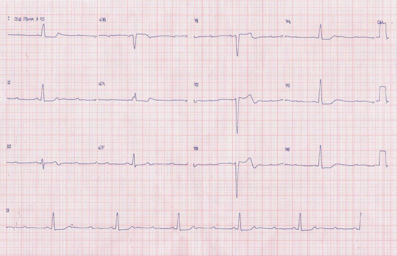 Mujer de 87 años que presenta episodio sincopal por presentar BAV 3:1 a quién se implanta MP transitorio que se desplaza