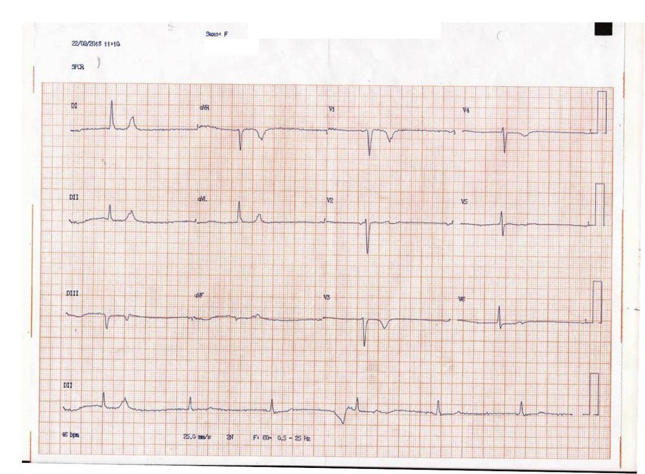 Mujer de 74 años, HTA y DBT que presenta fatiga y presíncope por presentar bigeminismo auricular bloqueado que determina baja frecuencia ventricular