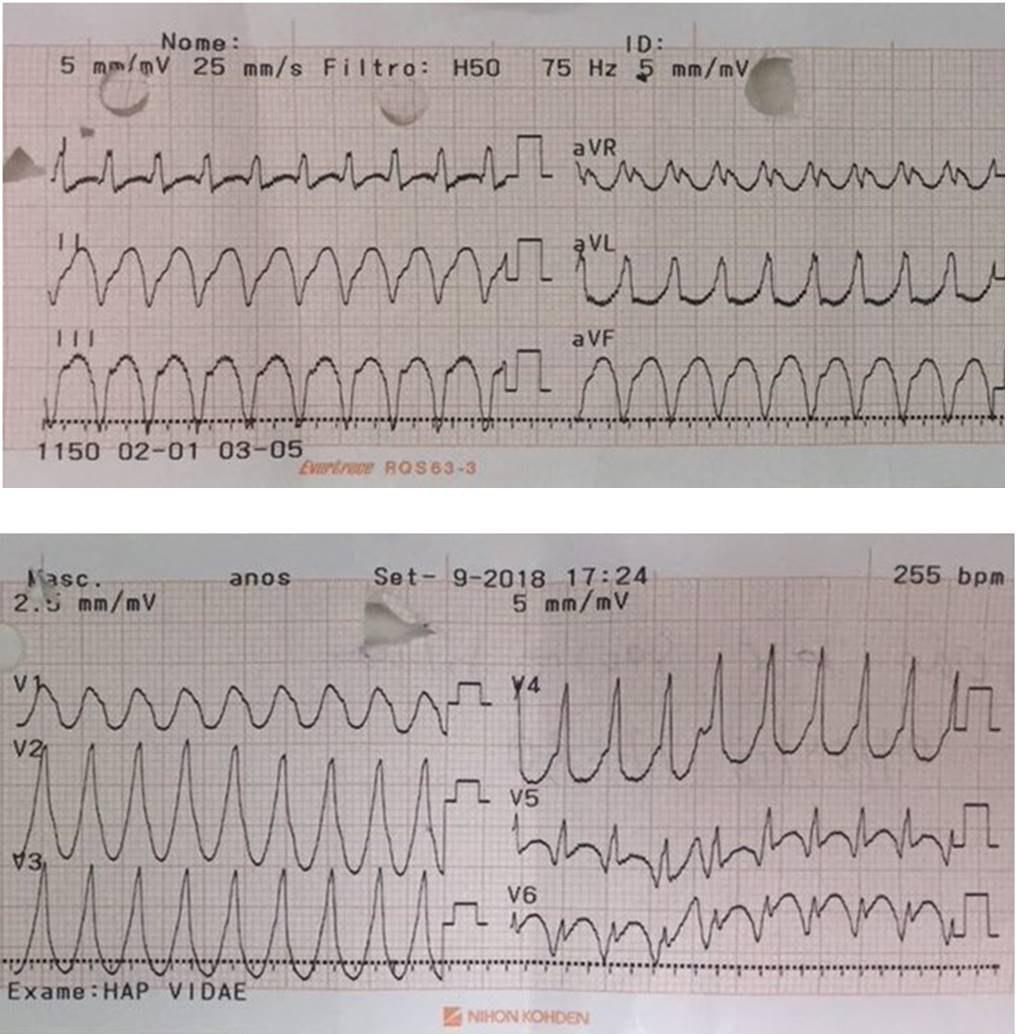 Paciente masculino de 49 años que presenta taquicardia de QRS ancho a quién se realiza EEF donde se induce TV de idéntica morfología a la taquicardia espontánea
