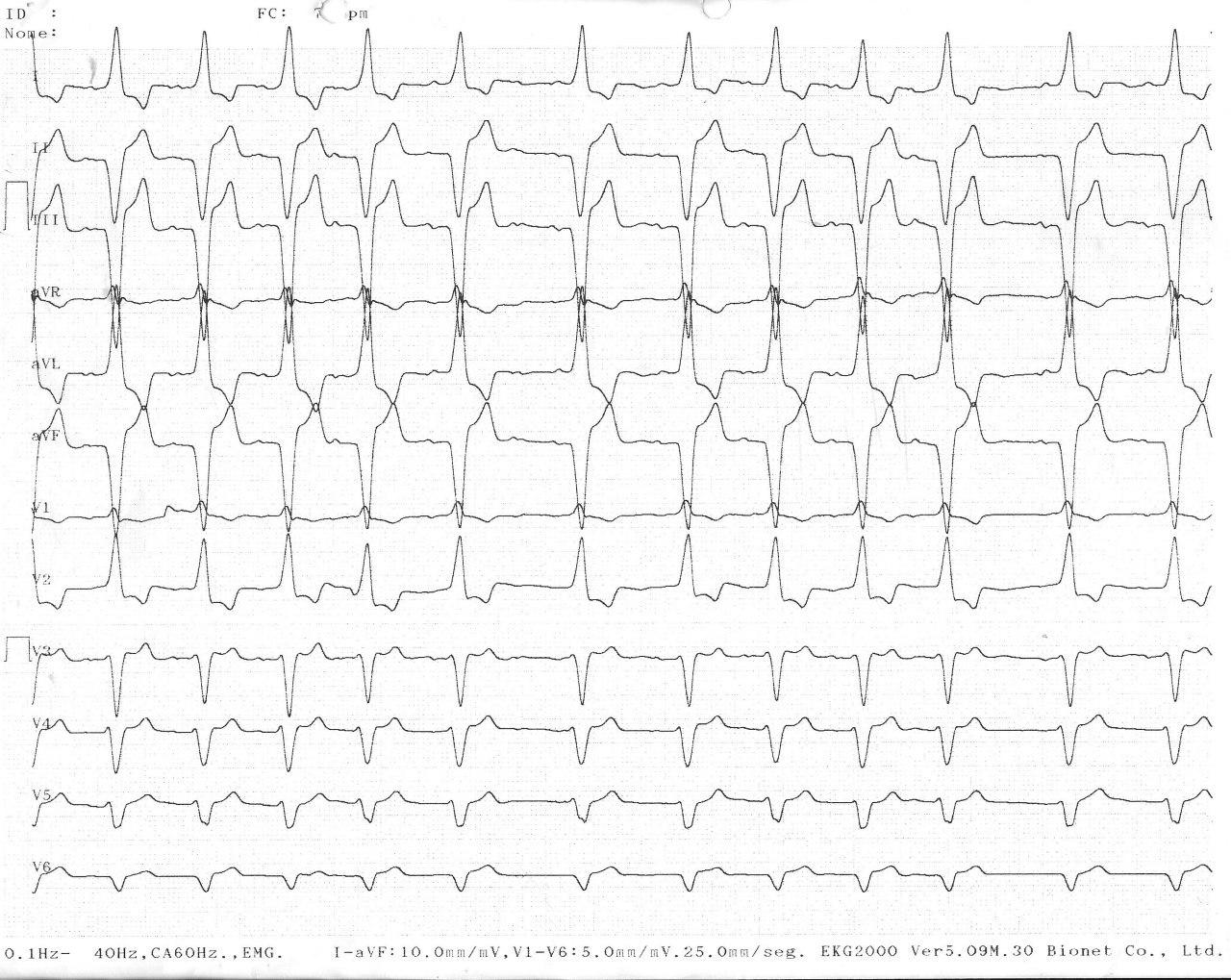 Mujer de 83 años portadora de marcapasos bicameral que presenta ECG con patrón de BRD en precordiales y BRI en derivaciones periféricas asociada a cardiopatía estructural severa de mal pronóstico